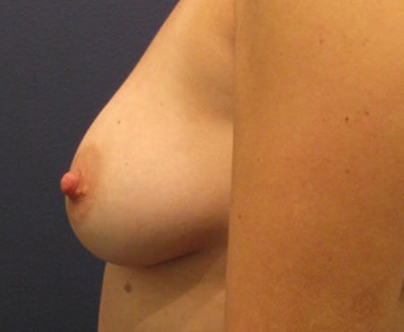 Fat Grafting Before & After Gallery - Patient 174146591 - Image 4