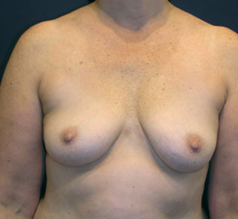Fat Grafting Before & After Gallery - Patient 174146596 - Image 1
