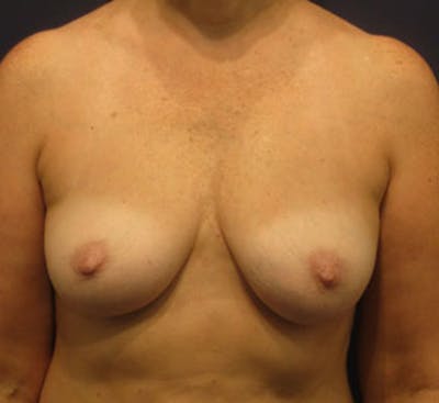 Fat Grafting Before & After Gallery - Patient 174146596 - Image 2