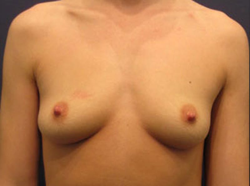 Fat Grafting Before & After Gallery - Patient 174146600 - Image 1