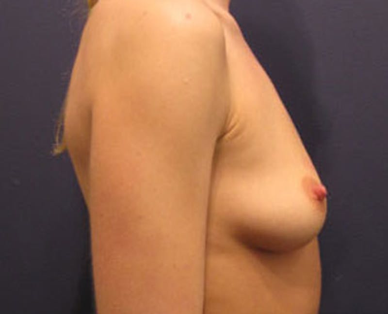 Fat Grafting Before & After Gallery - Patient 174146600 - Image 3