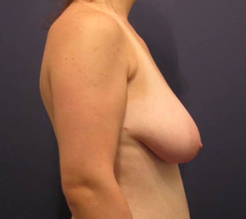 Fat Grafting Before & After Gallery - Patient 174146606 - Image 4