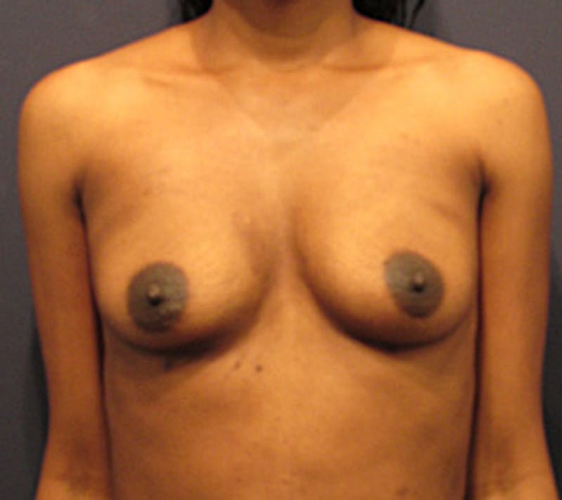 Fat Grafting Before & After Gallery - Patient 174146611 - Image 2