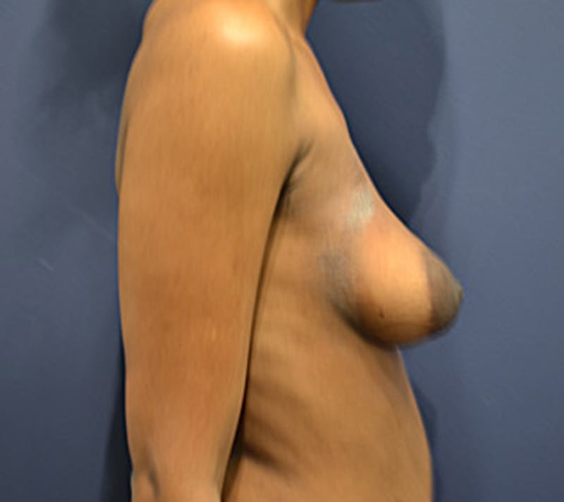 Fat Grafting Before & After Gallery - Patient 174146611 - Image 3