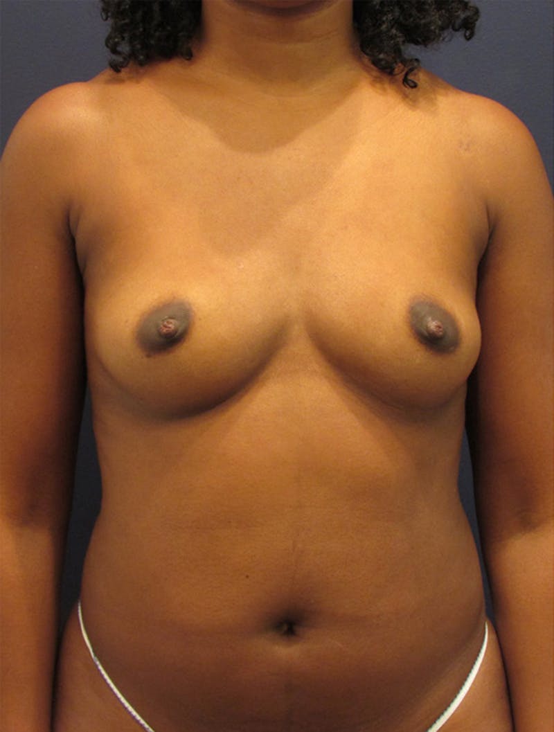 Fat Grafting Before & After Gallery - Patient 174146624 - Image 1