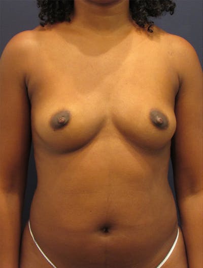 Fat Grafting Before & After Gallery - Patient 174146624 - Image 1