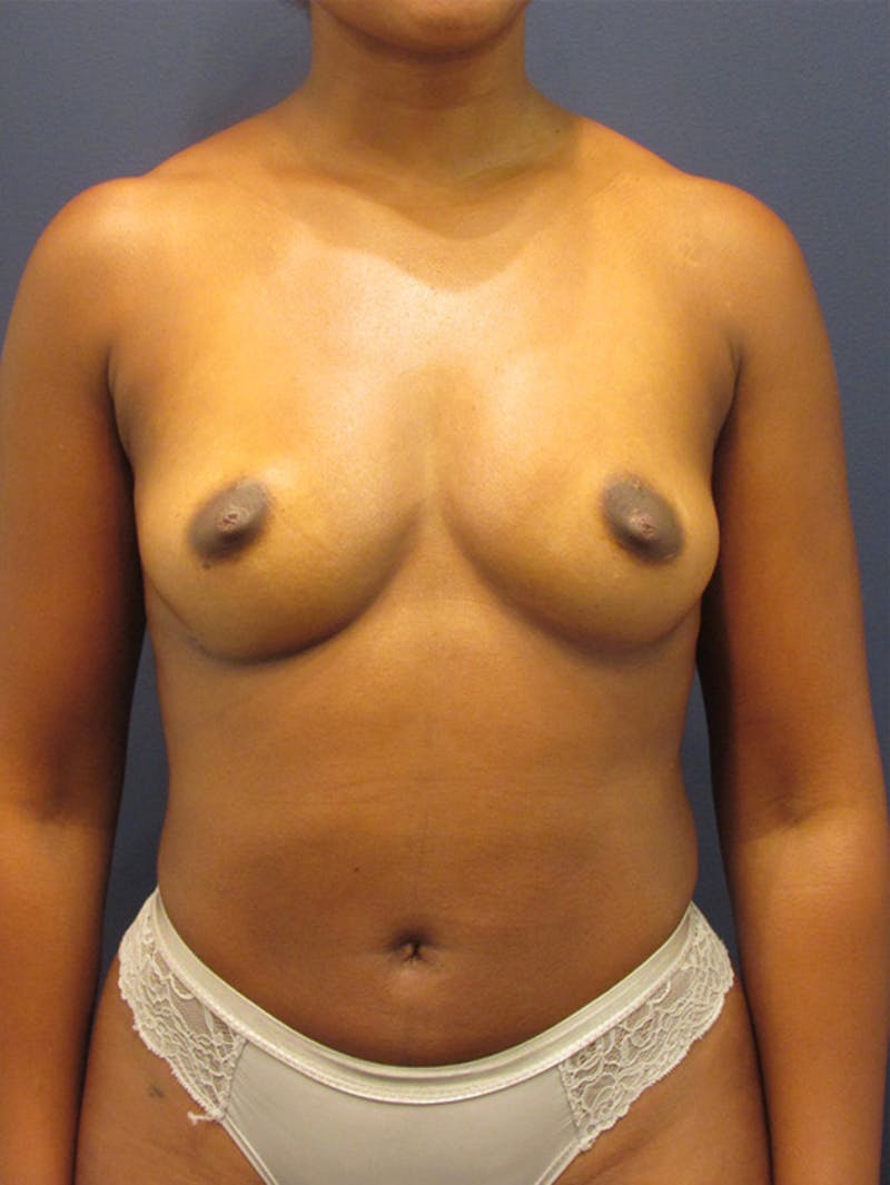 Fat Grafting Before & After Gallery - Patient 174146624 - Image 2