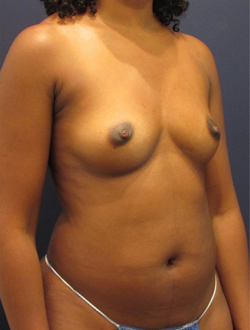 Fat Grafting Before & After Gallery - Patient 174146624 - Image 3