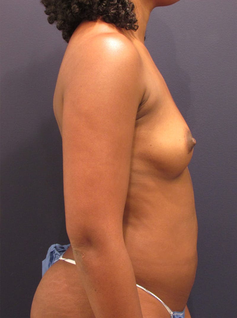 Fat Grafting Before & After Gallery - Patient 174146624 - Image 5