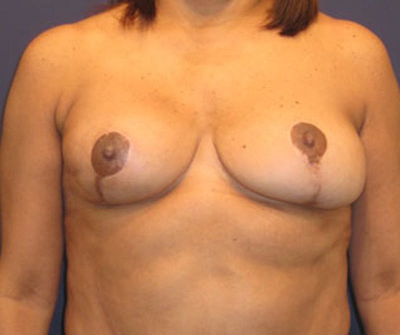 Fat Grafting Before & After Gallery - Patient 174147708 - Image 1