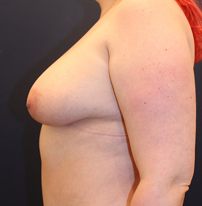 Fat Grafting Before & After Gallery - Patient 174147717 - Image 4