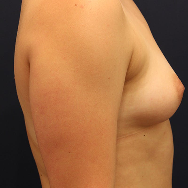 Fat Grafting Before & After Gallery - Patient 174147793 - Image 5