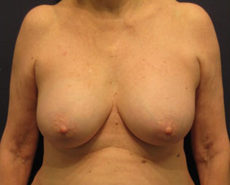 Breast Implant Revision Before & After Gallery - Patient 174146589 - Image 1