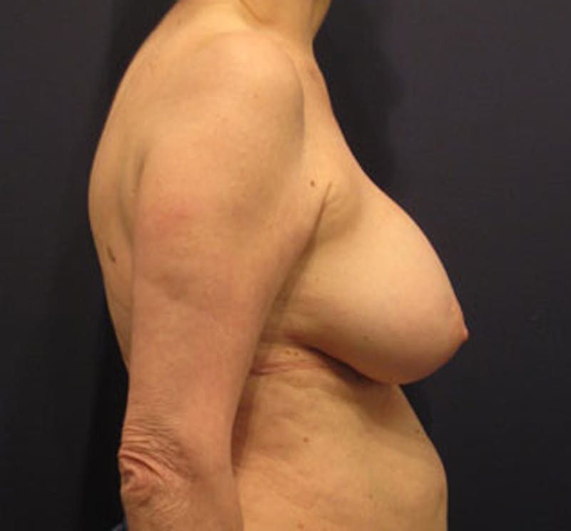 Breast Implant Revision Before & After Gallery - Patient 174146589 - Image 5