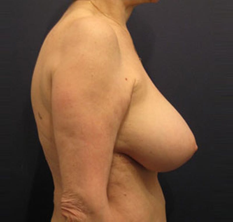 Breast Implant Revision Before & After Gallery - Patient 174146589 - Image 6