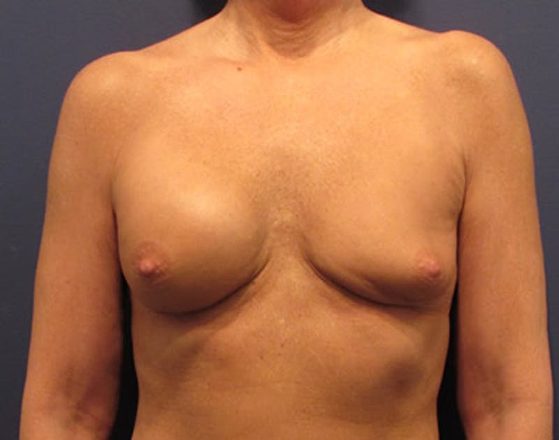 Breast Implant Revision Before & After Gallery - Patient 174146595 - Image 1