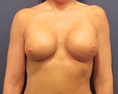 Breast Implant Revision Before & After Gallery - Patient 174146595 - Image 2