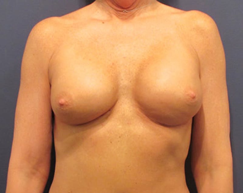 Breast Implant Revision Before & After Gallery - Patient 174146595 - Image 2
