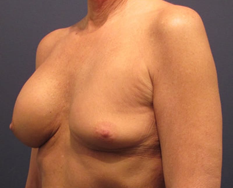 Breast Implant Revision Before & After Gallery - Patient 174146595 - Image 3