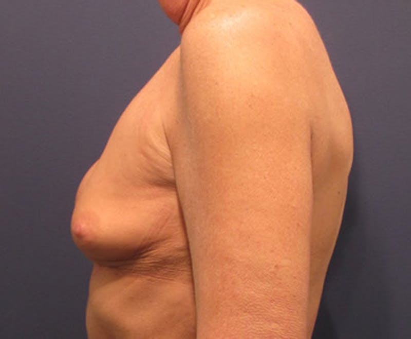 Breast Implant Revision Before & After Gallery - Patient 174146595 - Image 5