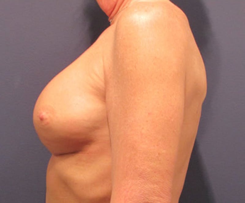 Breast Implant Revision Before & After Gallery - Patient 174146595 - Image 6