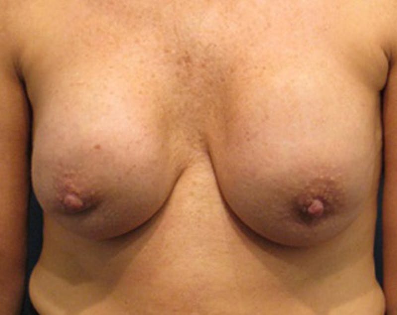 Breast Implant Revision Before & After Gallery - Patient 174146617 - Image 1