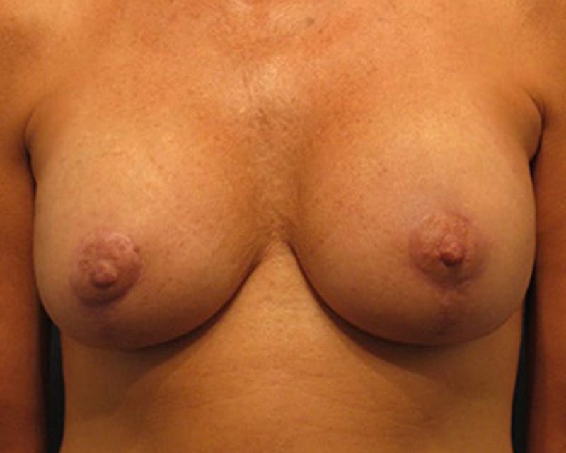 Breast Implant Revision Before & After Gallery - Patient 174146617 - Image 2