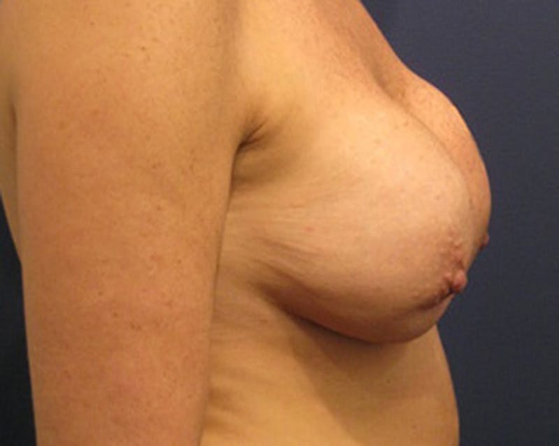 Breast Implant Revision Before & After Gallery - Patient 174146617 - Image 5