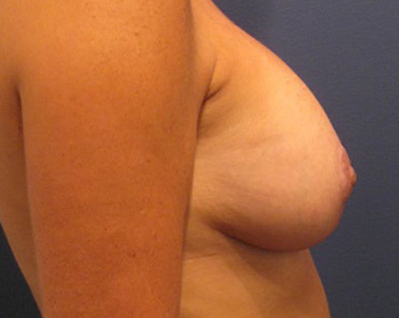 Breast Implant Revision Before & After Gallery - Patient 174146617 - Image 6