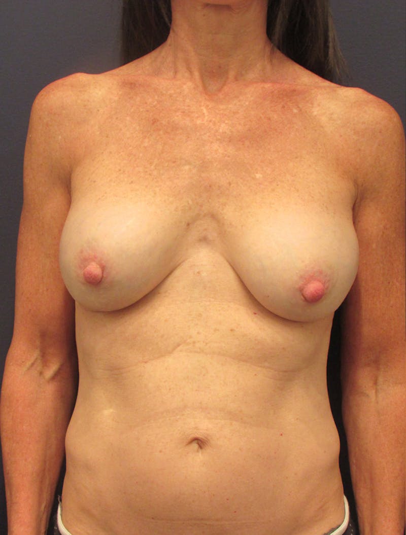 Breast Implant Revision Before & After Gallery - Patient 174148870 - Image 1