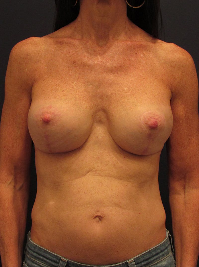 Breast Implant Revision Before & After Gallery - Patient 174148870 - Image 2