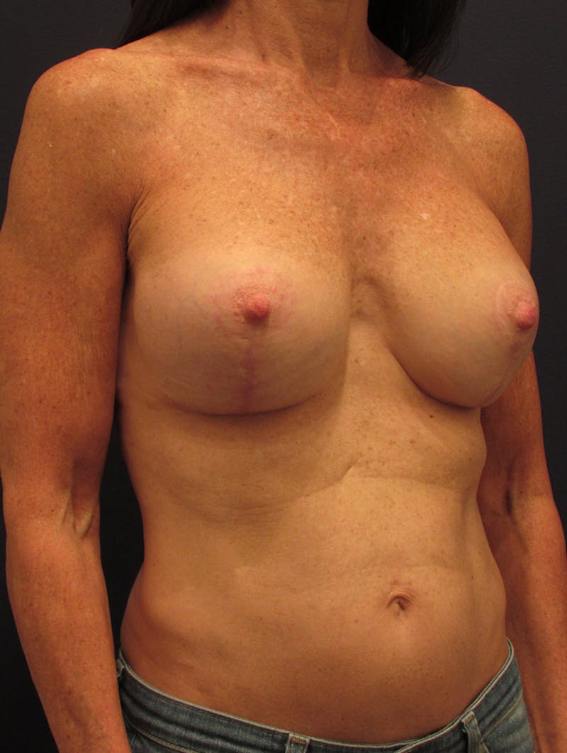 Breast Implant Revision Before & After Gallery - Patient 174148870 - Image 4