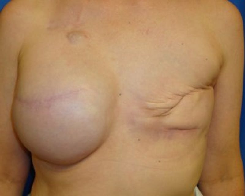 Breast Implant Revision Before & After Gallery - Patient 174149962 - Image 1
