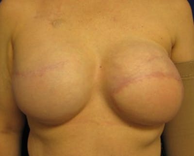 Breast Implant Revision Before & After Gallery - Patient 174149962 - Image 2