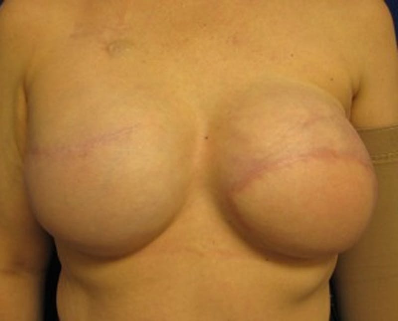 Breast Implant Revision Before & After Gallery - Patient 174149962 - Image 2