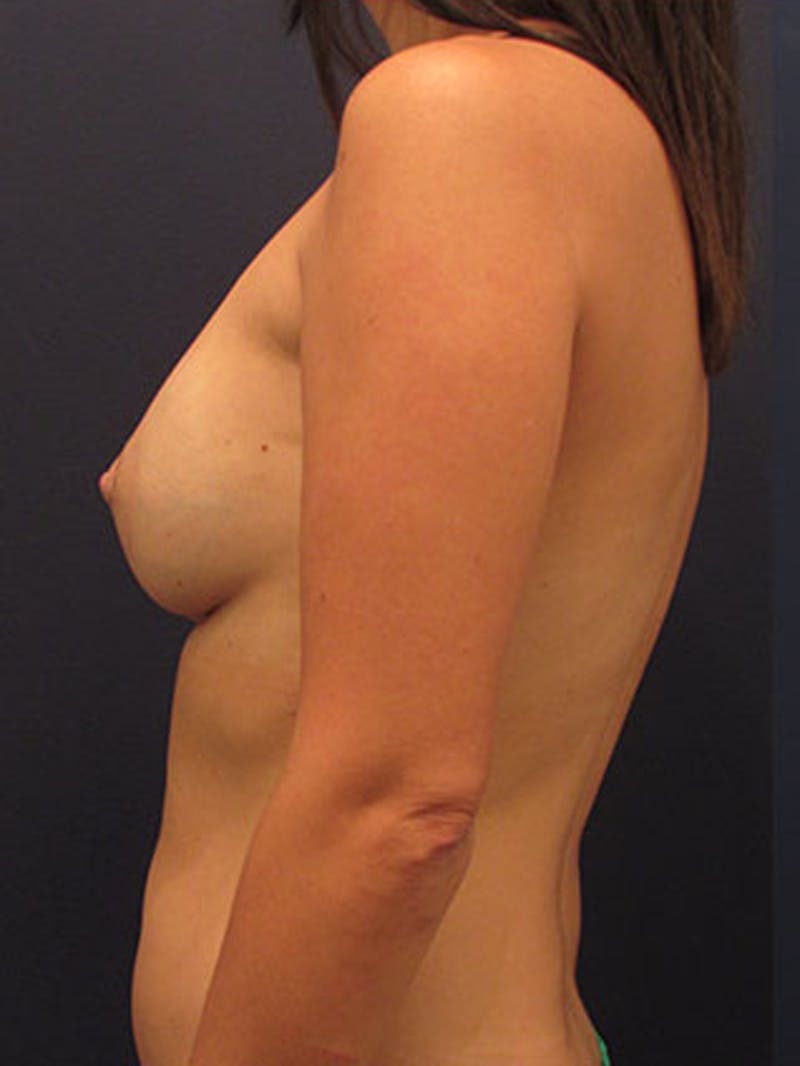 Breast Implant Revision Before & After Gallery - Patient 174149968 - Image 5