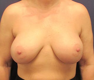 Breast Implant Revision Before & After Gallery - Patient 174149973 - Image 2