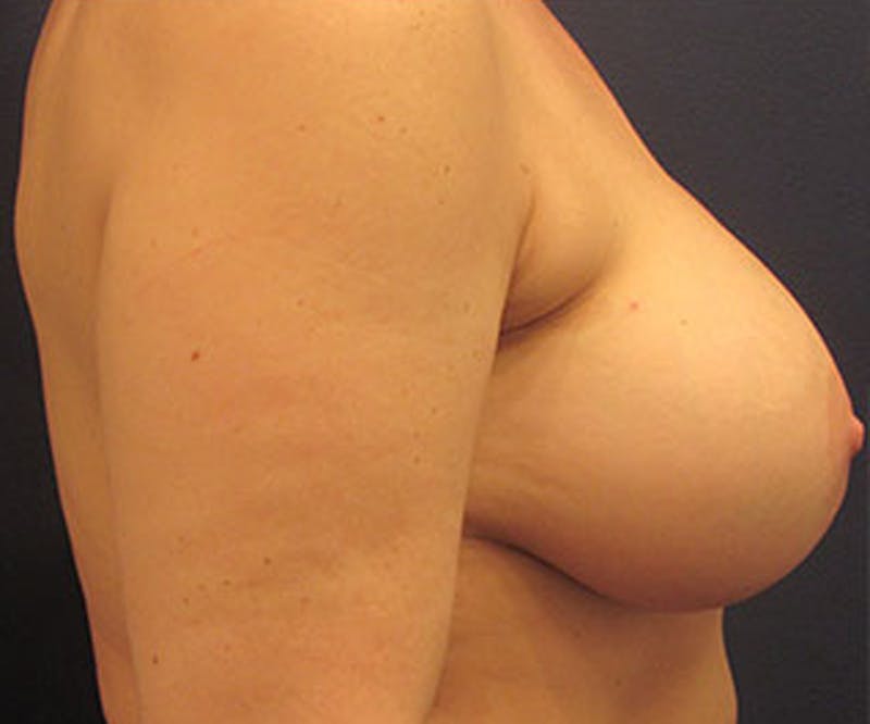 Breast Implant Revision Before & After Gallery - Patient 174149973 - Image 4