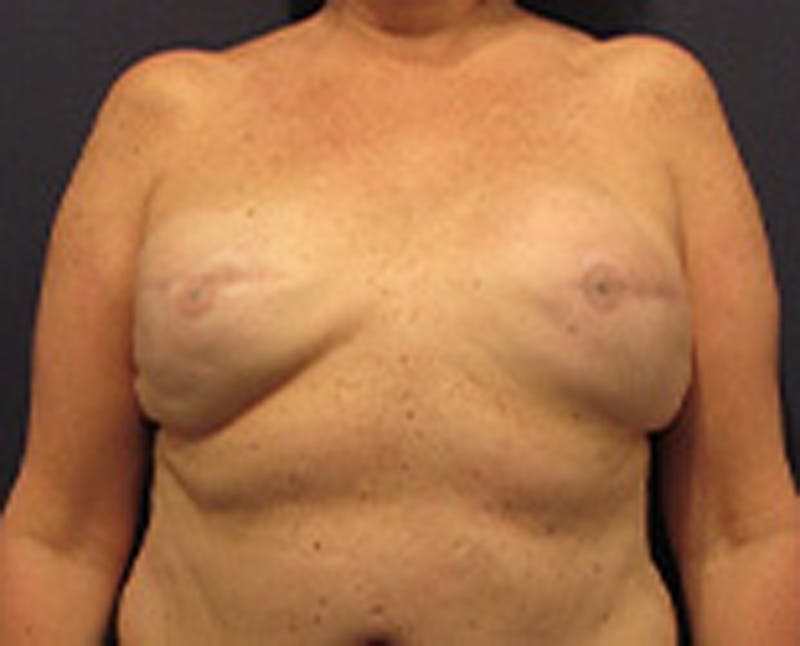Breast Implant Revision Before & After Gallery - Patient 174149981 - Image 1