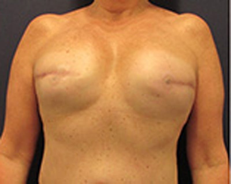 Breast Implant Revision Before & After Gallery - Patient 174149981 - Image 2
