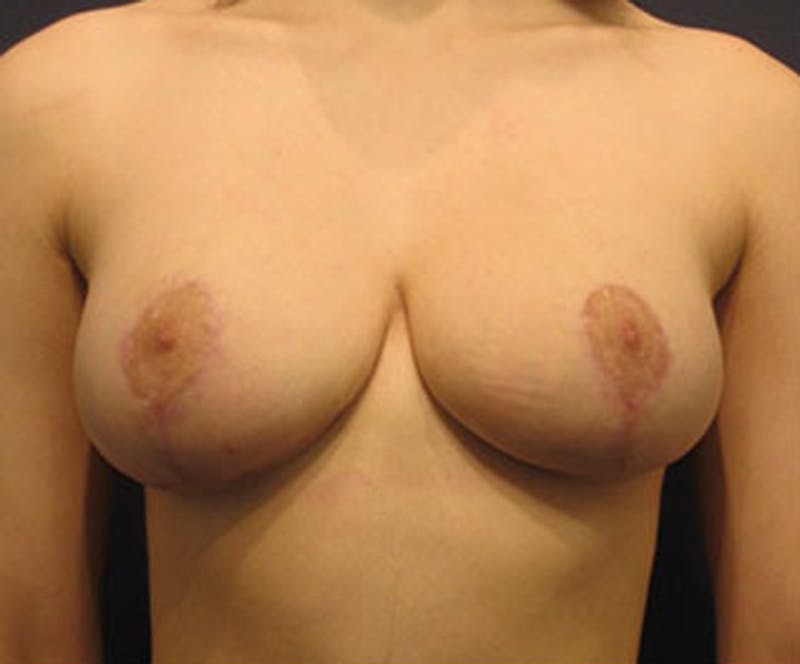 Breast Lift Before & After Gallery - Patient 174146592 - Image 2