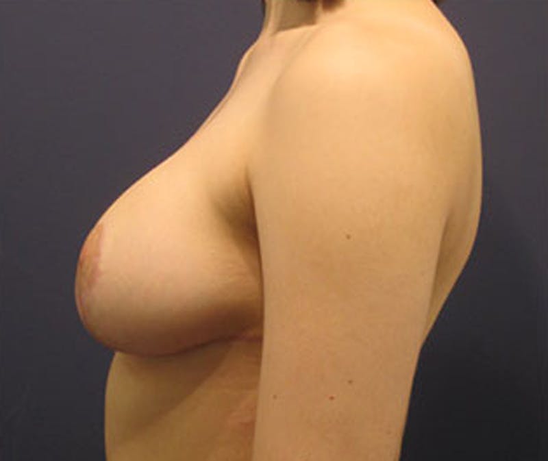 Breast Lift Before & After Gallery - Patient 174146592 - Image 4