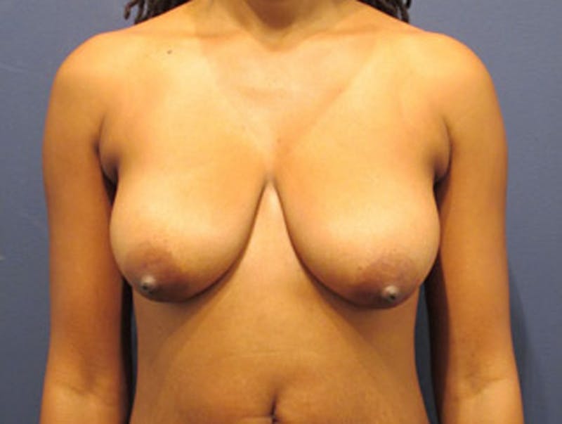 Breast Lift Before & After Gallery - Patient 174146599 - Image 1