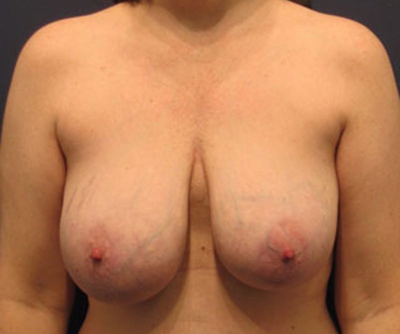Breast Lift Before & After Gallery - Patient 174146604 - Image 1