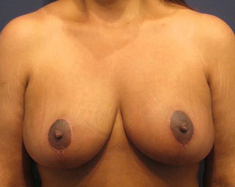 Breast Lift Before & After Gallery - Patient 174146608 - Image 2