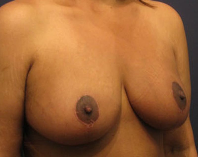 Breast Lift Before & After Gallery - Patient 174146608 - Image 4