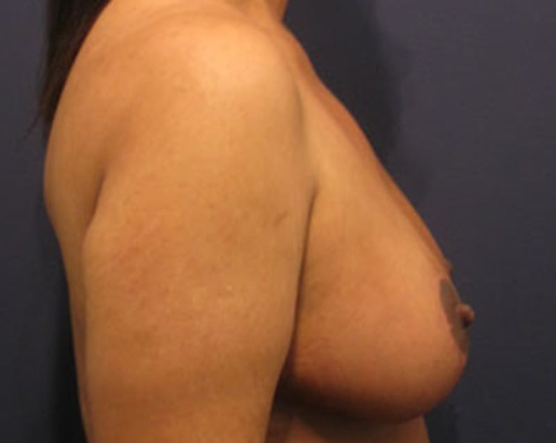 Breast Lift Before & After Gallery - Patient 174146608 - Image 6