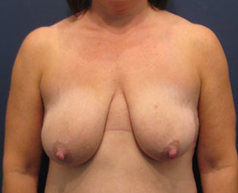 Breast Lift Before & After Gallery - Patient 174146615 - Image 1