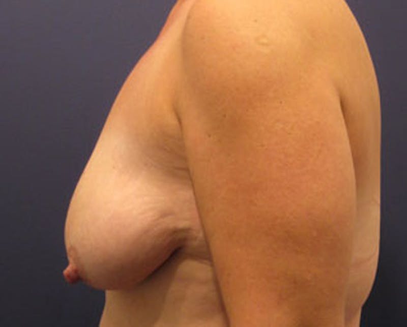 Breast Lift Before & After Gallery - Patient 174146615 - Image 5