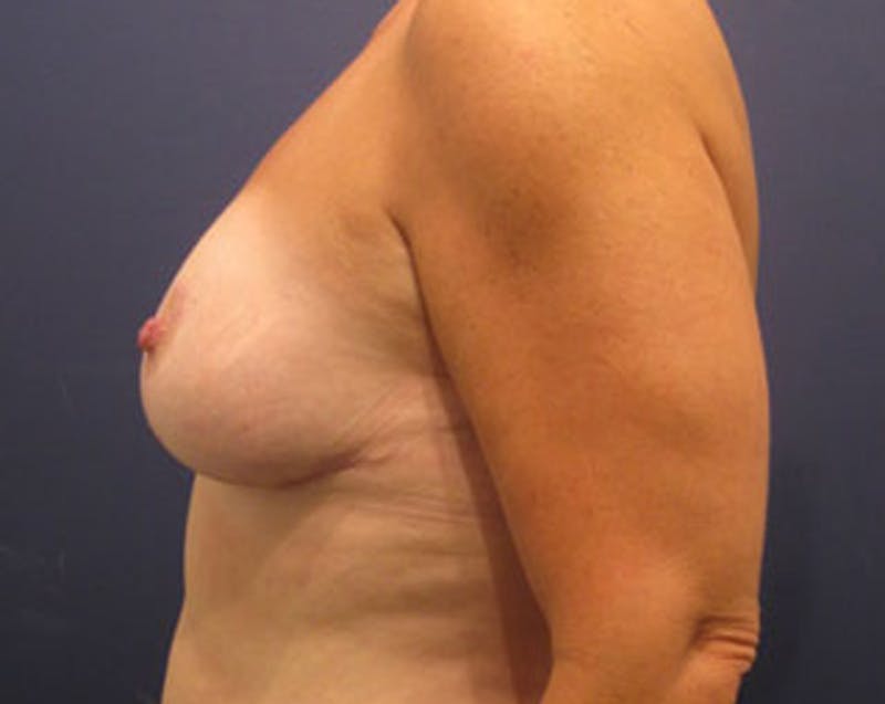 Breast Lift Before & After Gallery - Patient 174146615 - Image 6